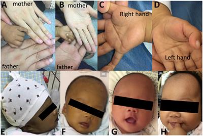 Novel Melanocortin 2 Receptor Variant in a Chinese Infant With Familial Glucocorticoid Deficiency Type 1, Case Report and Review of Literature